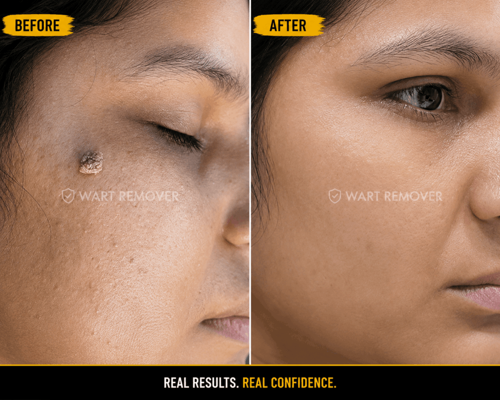 Best Wart remover Cream