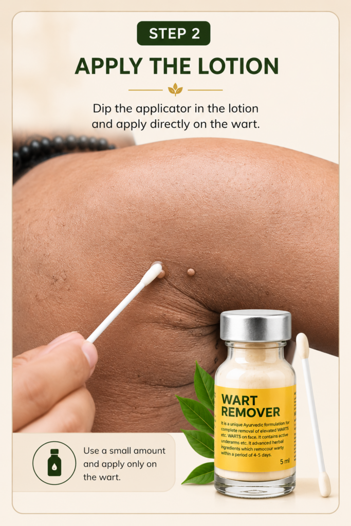 wart remover ointment