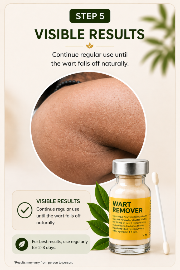 Best Wart remover Cream